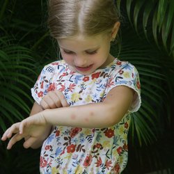 Insektenstichheiler-Test bei Stiftung Warentest: Das sind die 3 Sieger